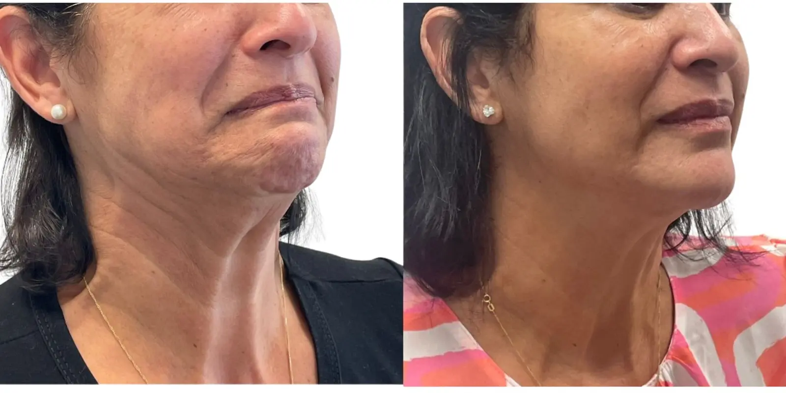 Antes e depois de toxina botulínica no pescoço em caso selecionado