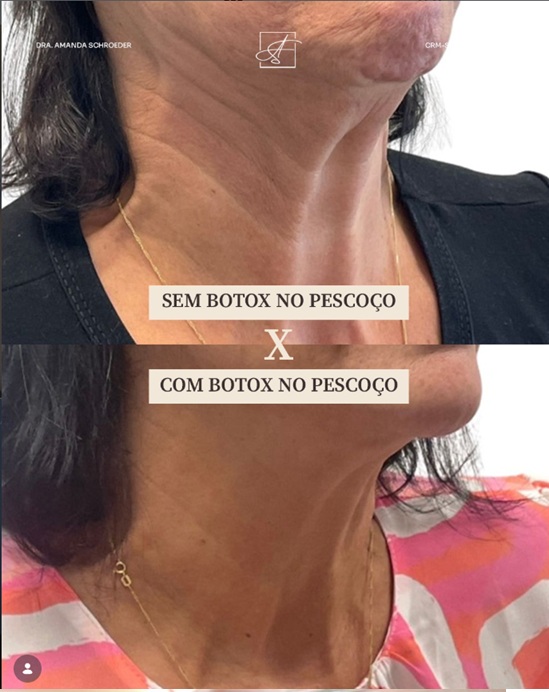 Resultado educativo de Botox no pescoço