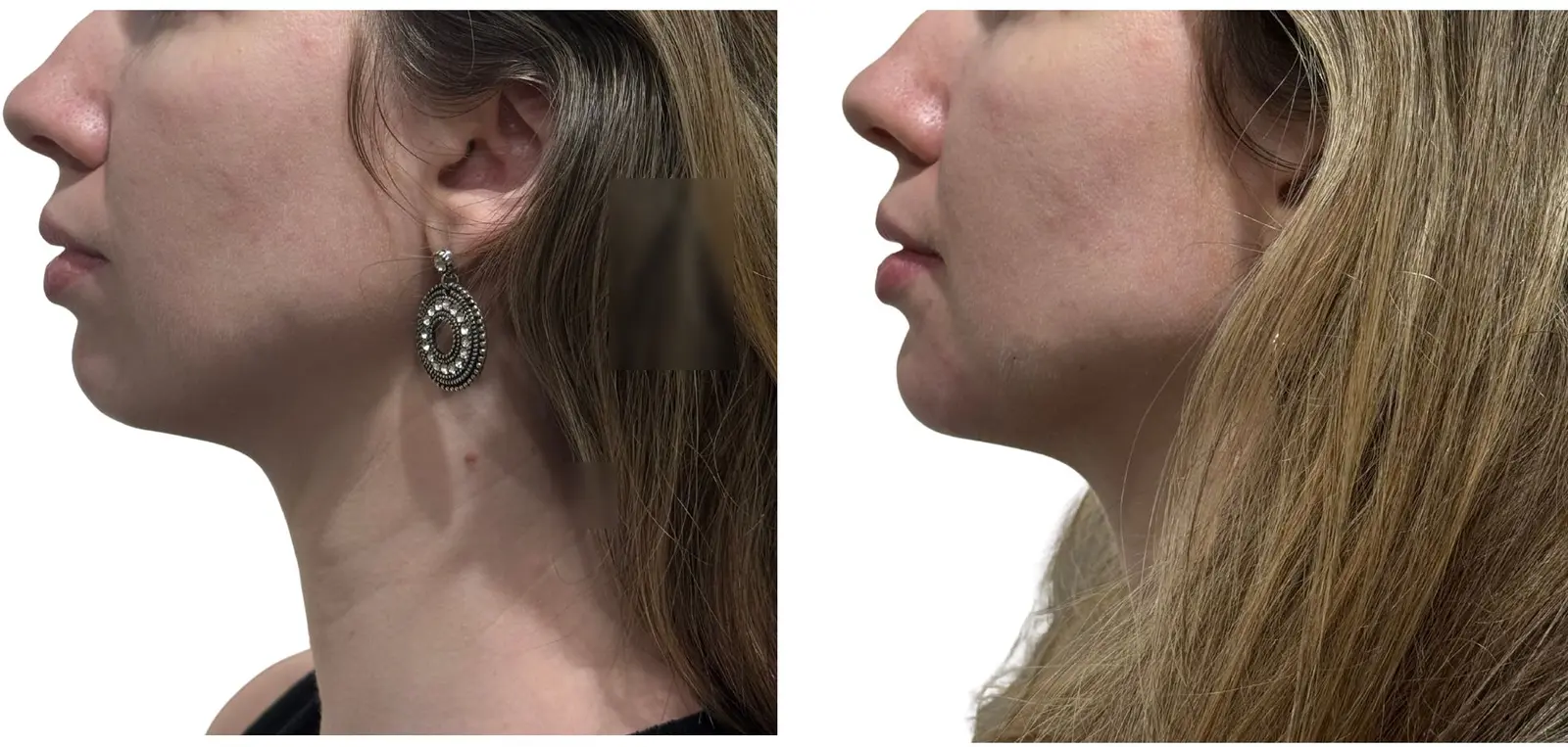 Antes e depois de preenchimento do queixo, caso real 1