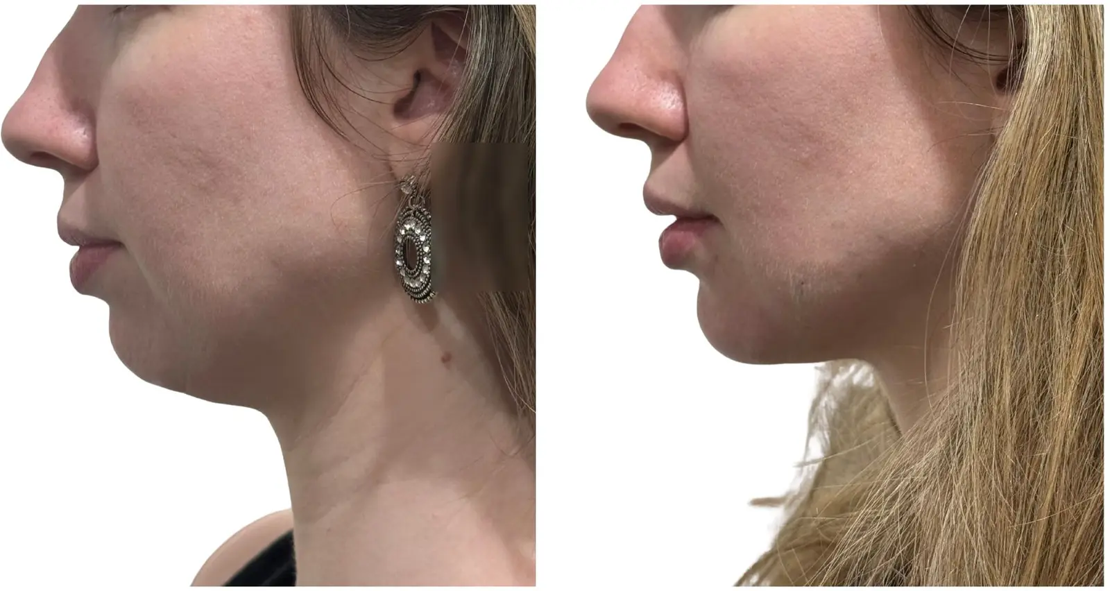 Antes e depois de preenchimento do queixo, caso real 2