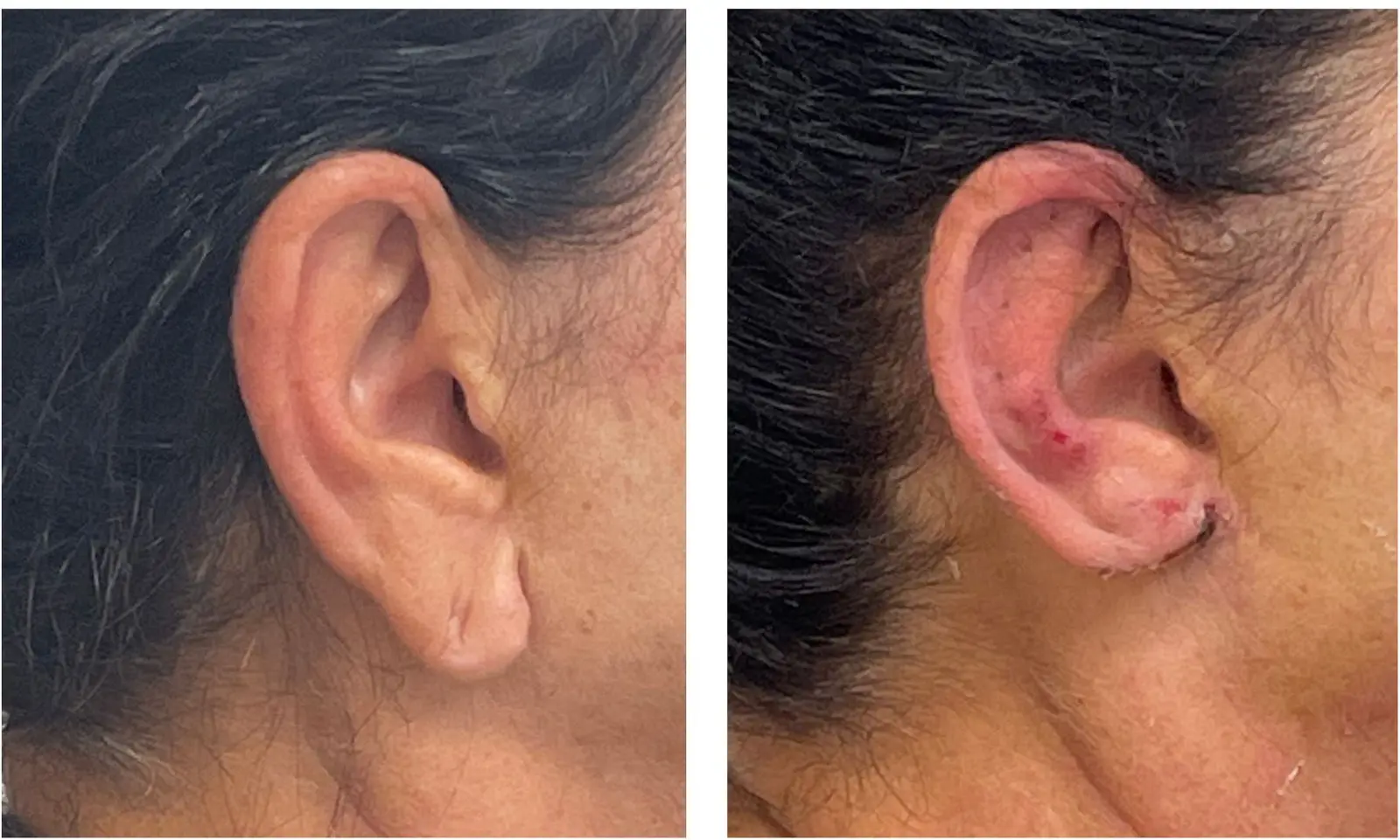 Resultado educativo de lobuloplastia antes e depois