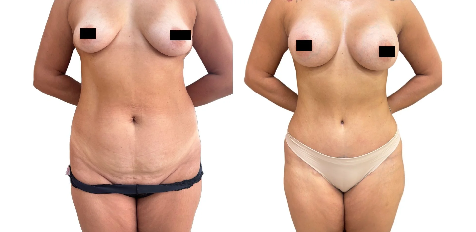 Antes e depois autorizado de cirurgia combinada de mama e abdome em vista frontal