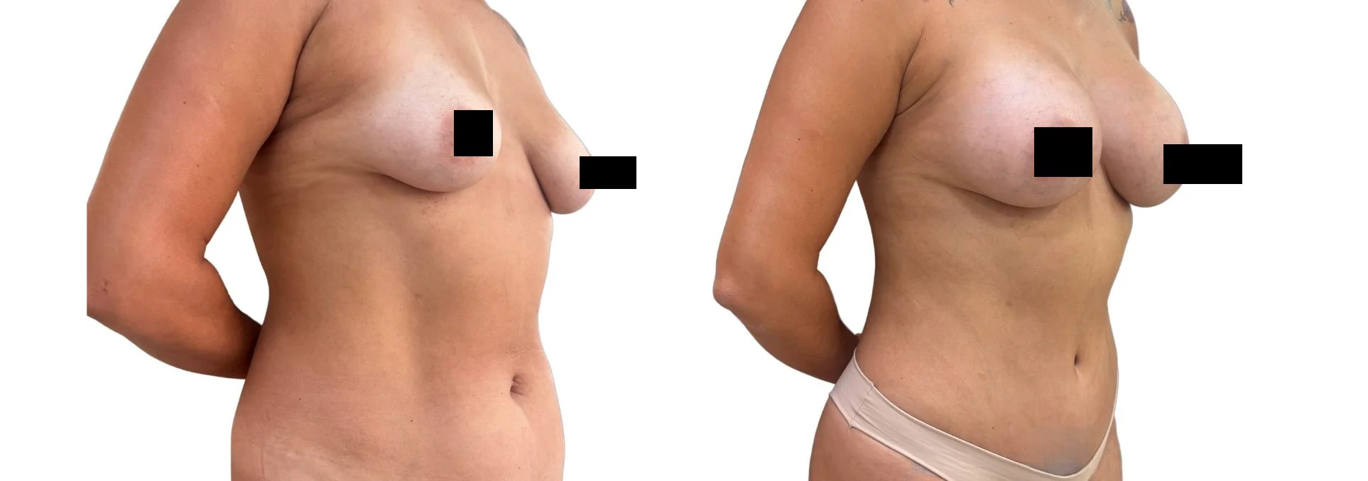 Antes e depois autorizado de cirurgia combinada de mama e abdome em vista oblíqua