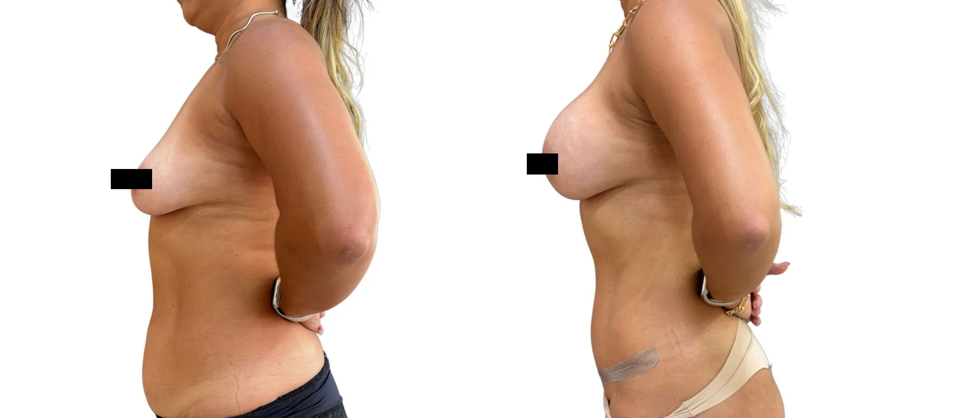 Antes e depois autorizado de cirurgia combinada de mama e abdome em vista de perfil