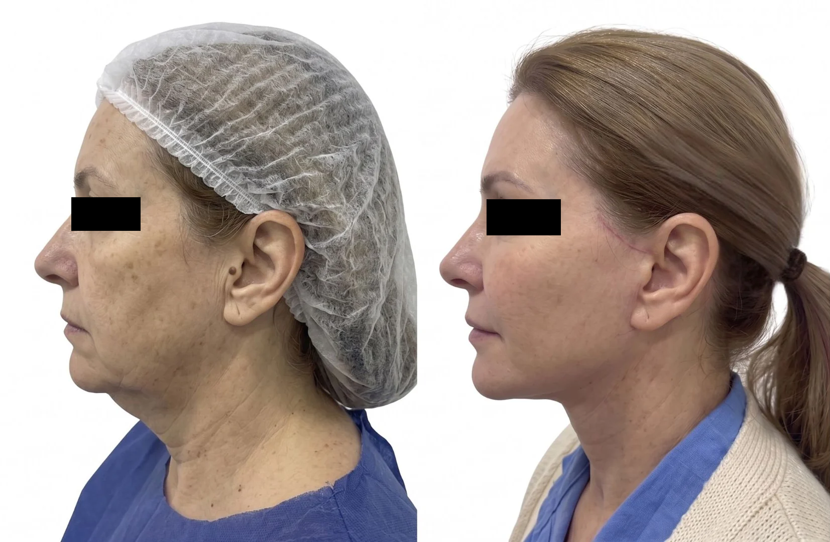 Antes e depois de lifting facial em perfil, caso real 3
