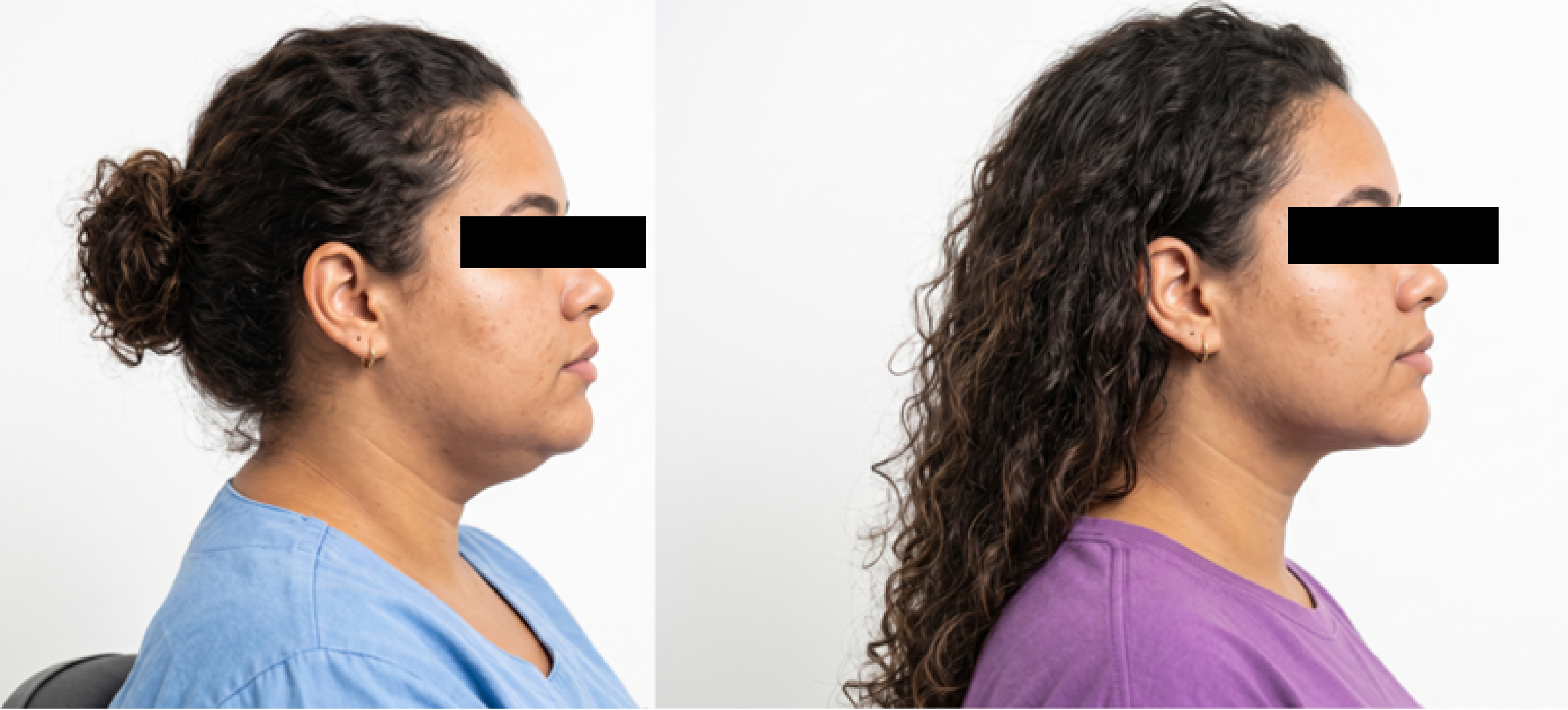 Antes e depois do contorno cervical, vista de perfil