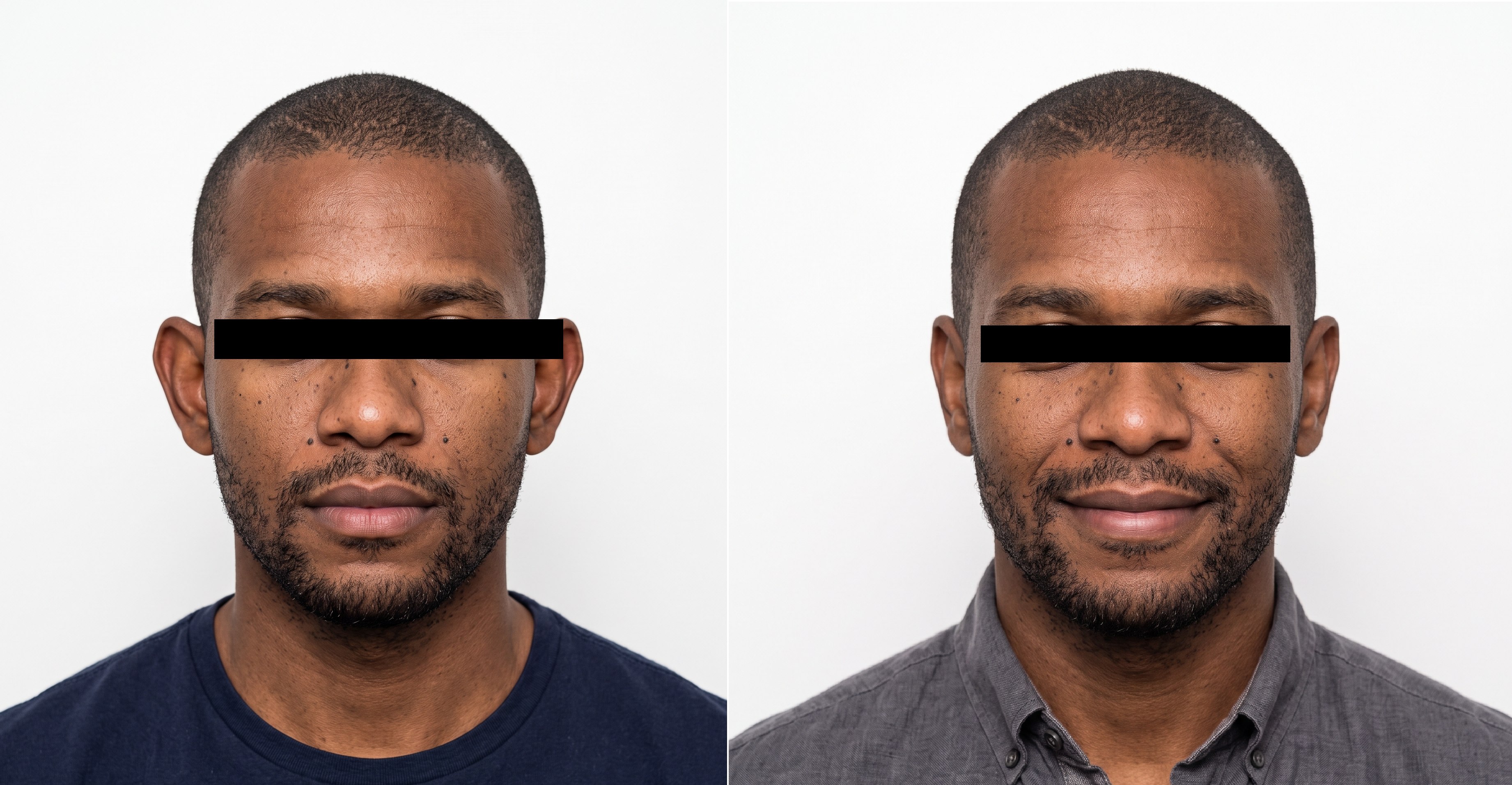 Resultado autorizado de otoplastia em adulto, antes e depois em vista frontal
