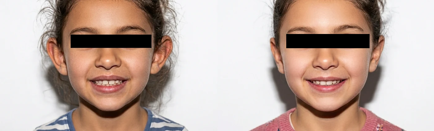 Resultado educativo de otoplastia antes e depois em vista frontal