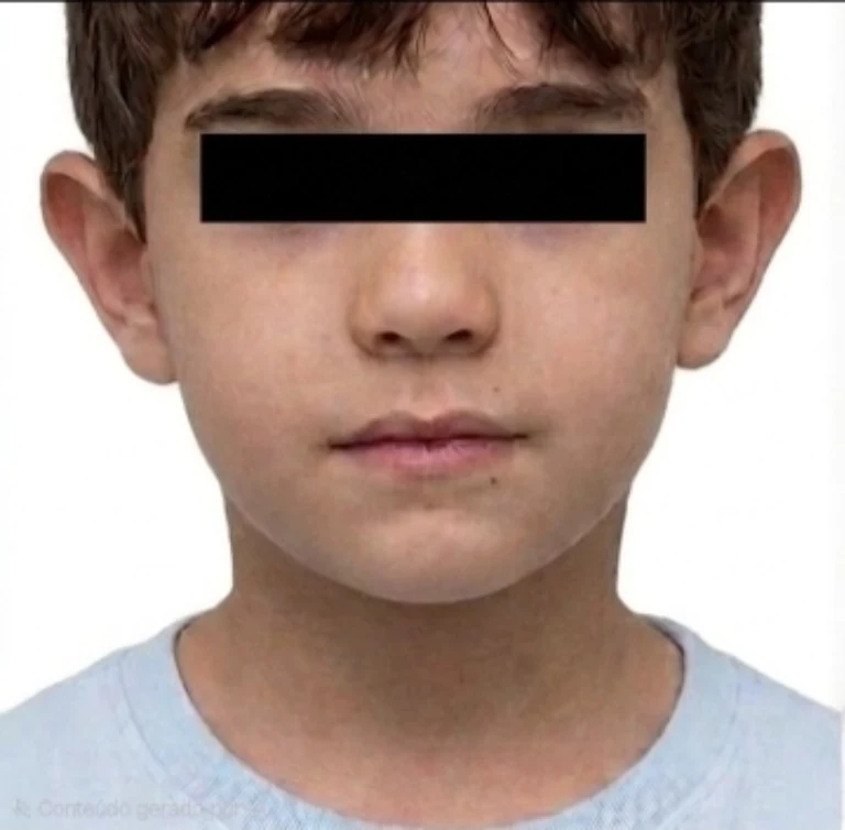 Vista frontal antes da otoplastia
