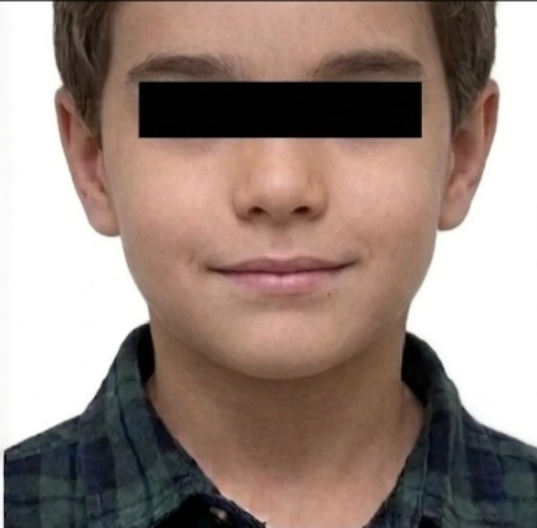 Vista frontal depois da otoplastia