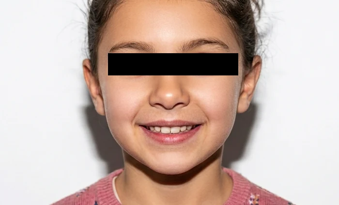 Vista frontal depois da otoplastia